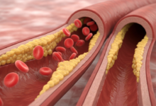 أعراض انسداد الشرايين المبكرة