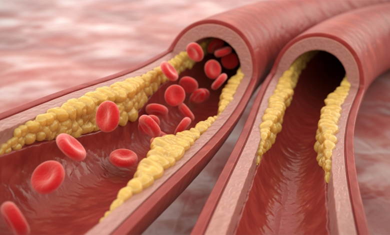 أعراض انسداد الشرايين المبكرة