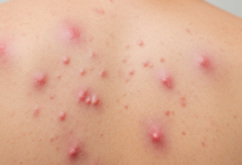 الذئبة الحمراء ما هو المفهوم الطبي لها