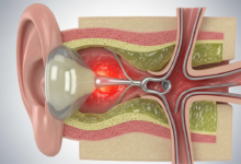 التهاب الأذن الوسطى