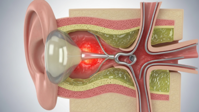 التهاب الأذن الوسطى