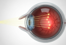 قصر النظر الأنواع والتصنيفات المختلفة له