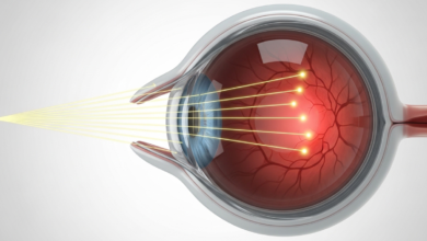 قصر النظر الأنواع والتصنيفات المختلفة له