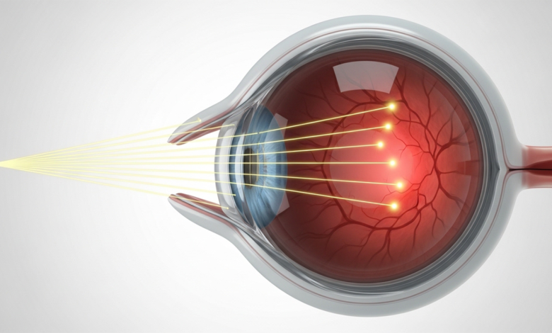 قصر النظر الأنواع والتصنيفات المختلفة له