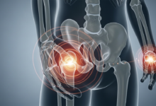 أمراض العظام والمفاصل| الأسباب والعلاج والوقاية