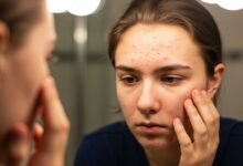 علاج مشاكل البشرة الناتجة عن التغيرات الهرمونية فترة الشباب