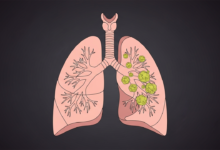 أعراض سرطان الرئة المبكرة