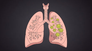 أعراض سرطان الرئة المبكرة