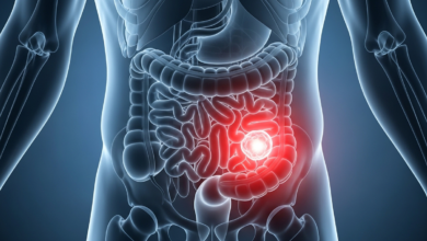 أعراض سرطان القولون المبكرة