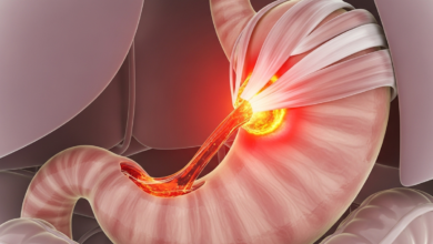 ارتجاع المريء