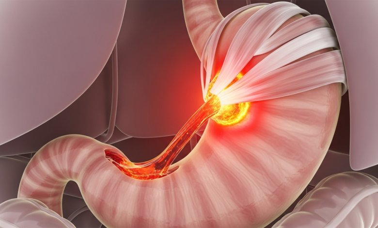 ارتجاع المريء