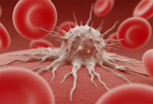 السرطان الأنواع والأعراض وطرق العلاج الحديثة السرطان