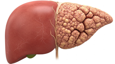 تليف الكبد